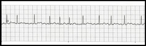 Practice EKG Rhythm Strips 164