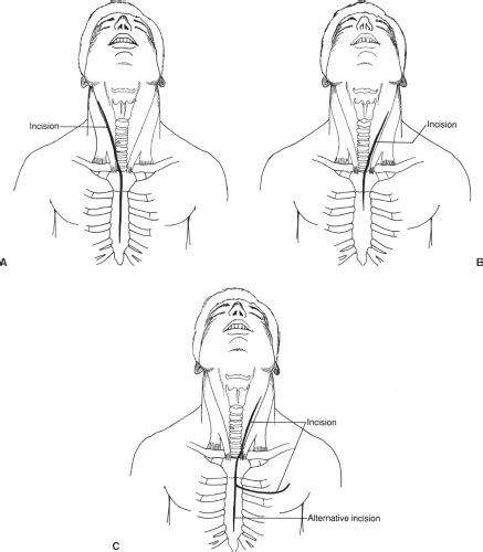 Neck Exploration for Trauma | Basicmedical Key