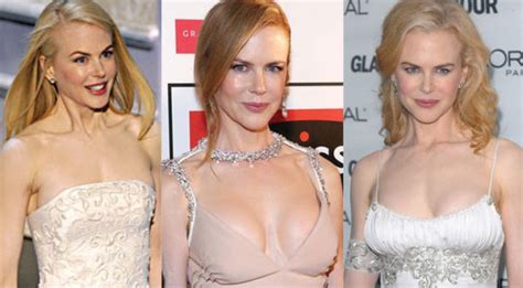 Nicole Kidman Plastic Surgery Before and After Pictures 2024