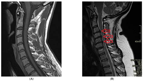 Cervical Spine Mri Comparison