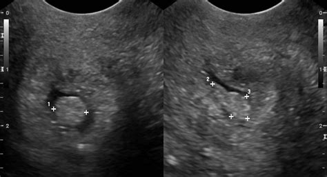 Cervical polyp | Cervical, Polyp, Heavy menstrual bleeding