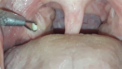 tonsil stones removal - YouTube