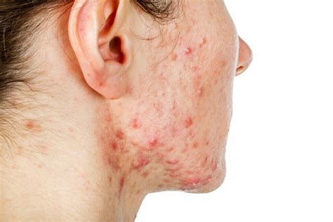 Nodular acne: everything you need to know