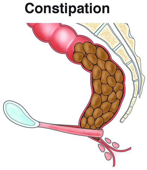 “Understanding Constipation: Causes and Prevention” – Constipation