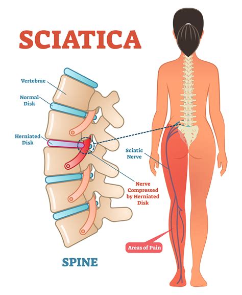 Sciatica Pain Relief - Anatomy & Definition — Revive Sport & Spine