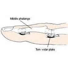 Volar plate injury - Symptoms, Causes & Treatment.