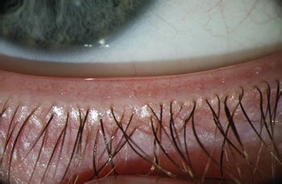 The Form and Function of Meibomian Glands