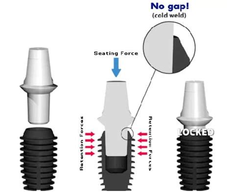 Comparison Of Implant/Abutment Connection Types