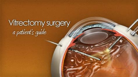 Vitrectomy eye surgery for floaters and vitreous hemorrhage ...