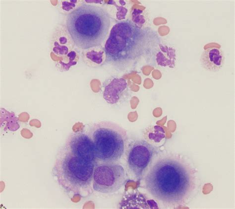 Mesothelial cells in pleural fluid | eClinpath