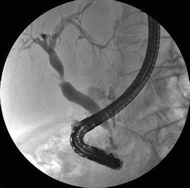 Preoperative Biliary Drainage: Methods, Advantages, and Complications ...