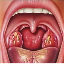 Mucus in Throat, Hard to Breathe: Causes and Treatment | New Health Advisor