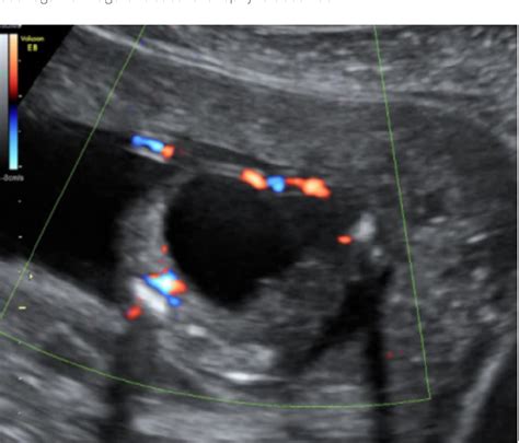 Figure 1 from Cloacal exstrophy, a rare fetal malformation with ...