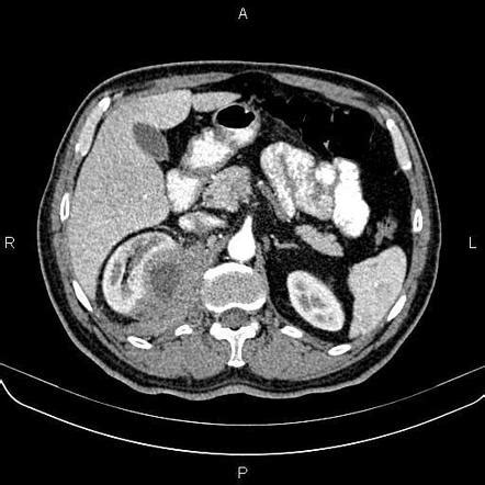 Perinephric abscess | Radiology Reference Article | Radiopaedia.org