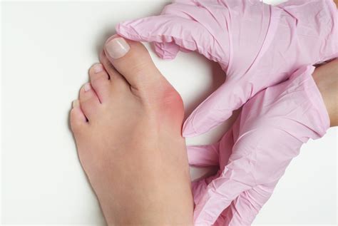 Bunion Surgery: How to Prepare and What You Should Know