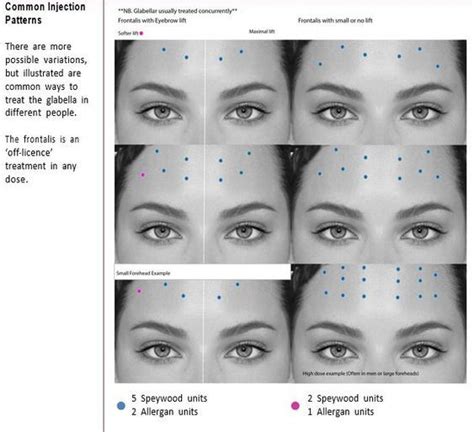 Forehead Botox injection pattern | Botox injection sites, Botox ...