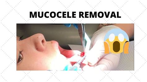 MUCOCELE REMOVAL PART 2 - YouTube | Mucus, Gland, Lips