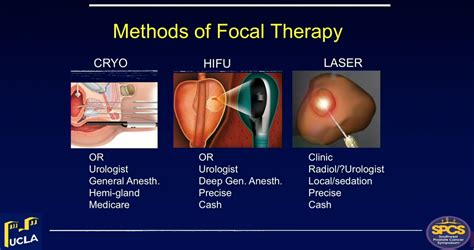 Focal Therapy of Prostate Cancer | Partial Gland Ablation