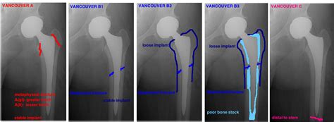 PERIPROSTHETIC FRACTURE — Hip & Knee Book