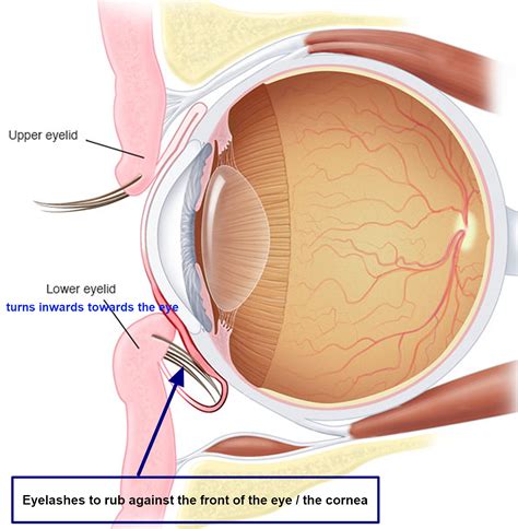 Entropion - Causes, Symptoms, Surgery, Treatment