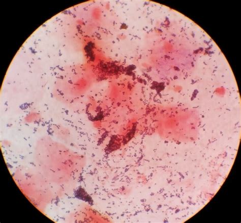 Sputum gram stain » Clinical Laboratory Science