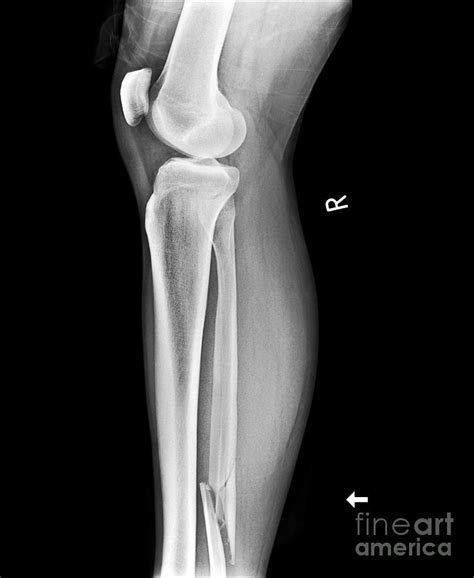 Broken Leg, X-ray Photograph by Science Photo Library