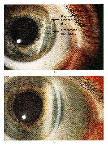 Kayser-Fleischer Ring with Wilson's Disease