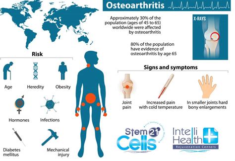 Rheumatoid Arthritis Stem Cell Therapy | Adult Stem Cell Therapy Abroad ...