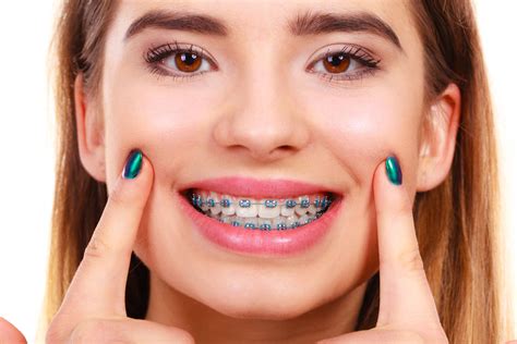 Woman smiling showing teeth with braces