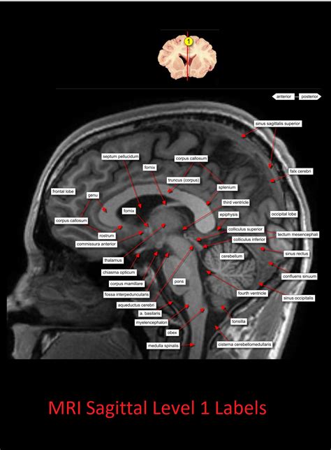 MRI Sagittal Anatomy of Brain Level 1 - NCLEX Quiz