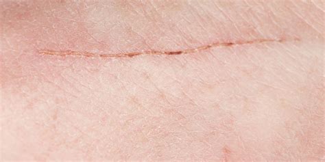 Stitches Scars: Causes & Treatments | La Roche-Posay