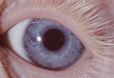 Albinism, Oculocutaneous, Type I | Hereditary Ocular Diseases