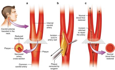 Monitoring for Carotid Endarterectomy | Neupsy Key