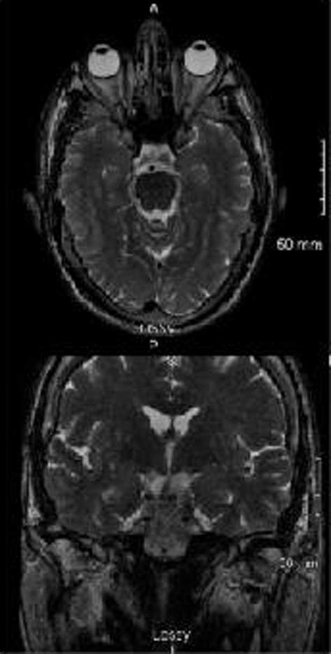 MRI of the brain with attention to the pituitary. | Download Scientific ...