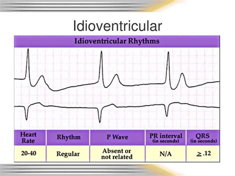 PPT - Rhythm & 12 Lead EKG Review PowerPoint Presentation - ID:6720077