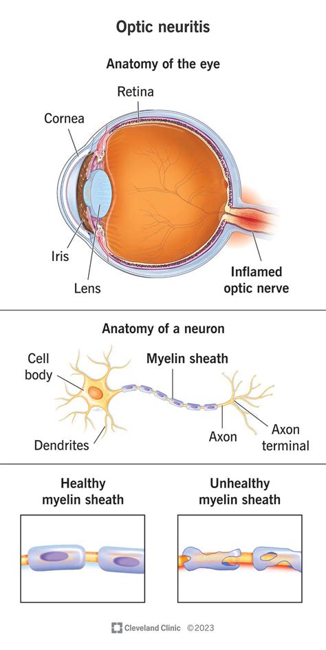 Optic Neuritis: Symptoms, Causes & Treatment Options