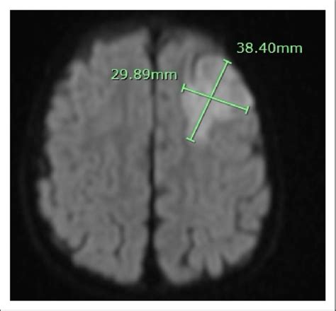 Diffusion-weighted brain MRI demonstrating 3.8 × 3 cm area of ...