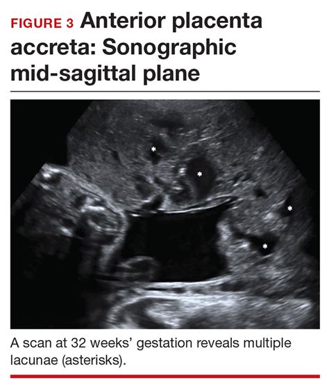 Diagnosing placenta accreta spectrum with prenatal ultrasound | MDedge ...