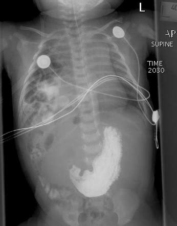 Bochdalek hernia features (mnemonic) | Radiology Reference Article ...