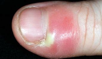 Infected Cuticles: Symptoms, Causes & Treatments – NailDesignCode