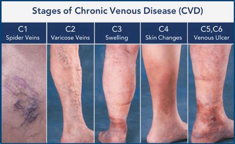 Chronic Venous Insufficiency Treatment Specialist - Vascular Health Center