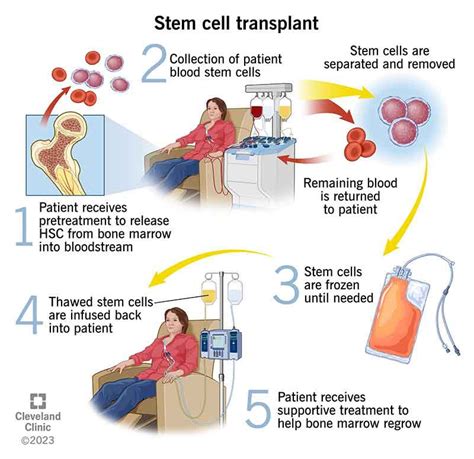 Bone Marrow Transplant Stem Cell