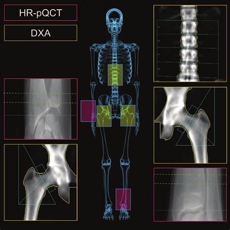 Locations of DXA and HR-pQCT measurements. Standardized DXA ...