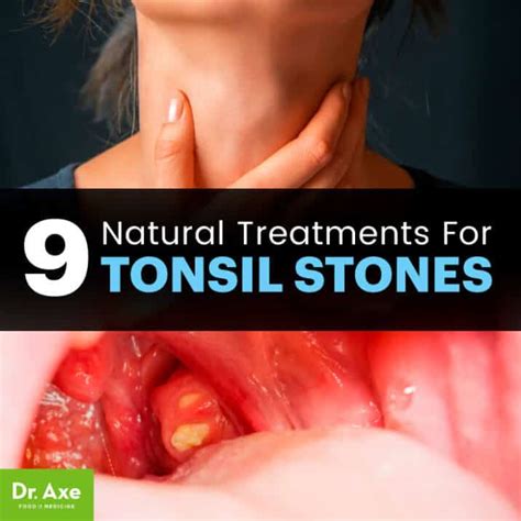 Tonsil Stones Causes, Symptoms and Treatment Options - Dr. Axe