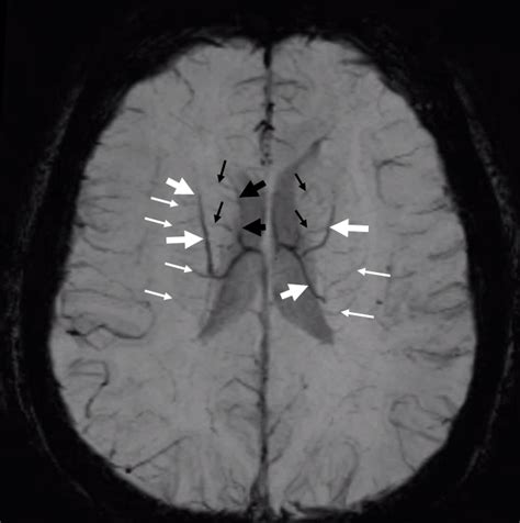 Internal Cerebral Vein | neuroangio.org