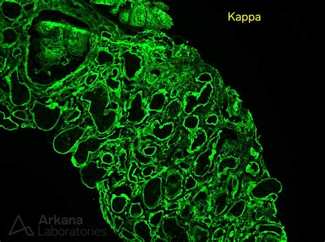 Light Chain Deposition Disease | Teaching Points | Arkana Laboratories