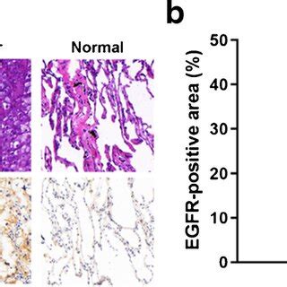 EGFR expression in human lung cancer and normal tissue. a... | Download ...