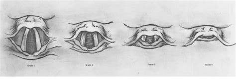 [Figure, Cormack-Lehane Grading System Contributed by Dr. Sean Hunt, DO ...