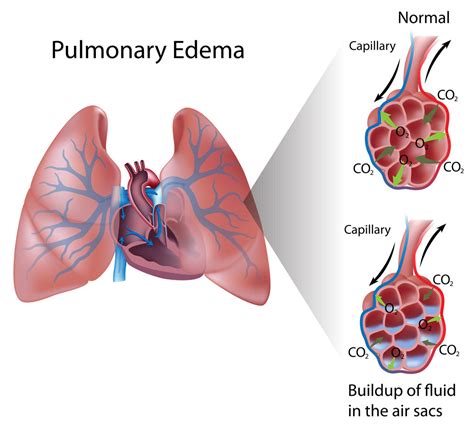 pulmonary-edema - Pediatric Pulmonologists