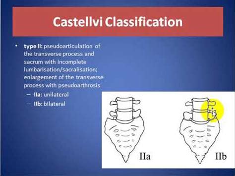 Lumbosacral Transitional Vertebra - YouTube